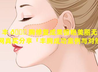 丰 🐈 胸修复成果惊艳美丽无忧网真实分享「丰胸成功案例与对照图」